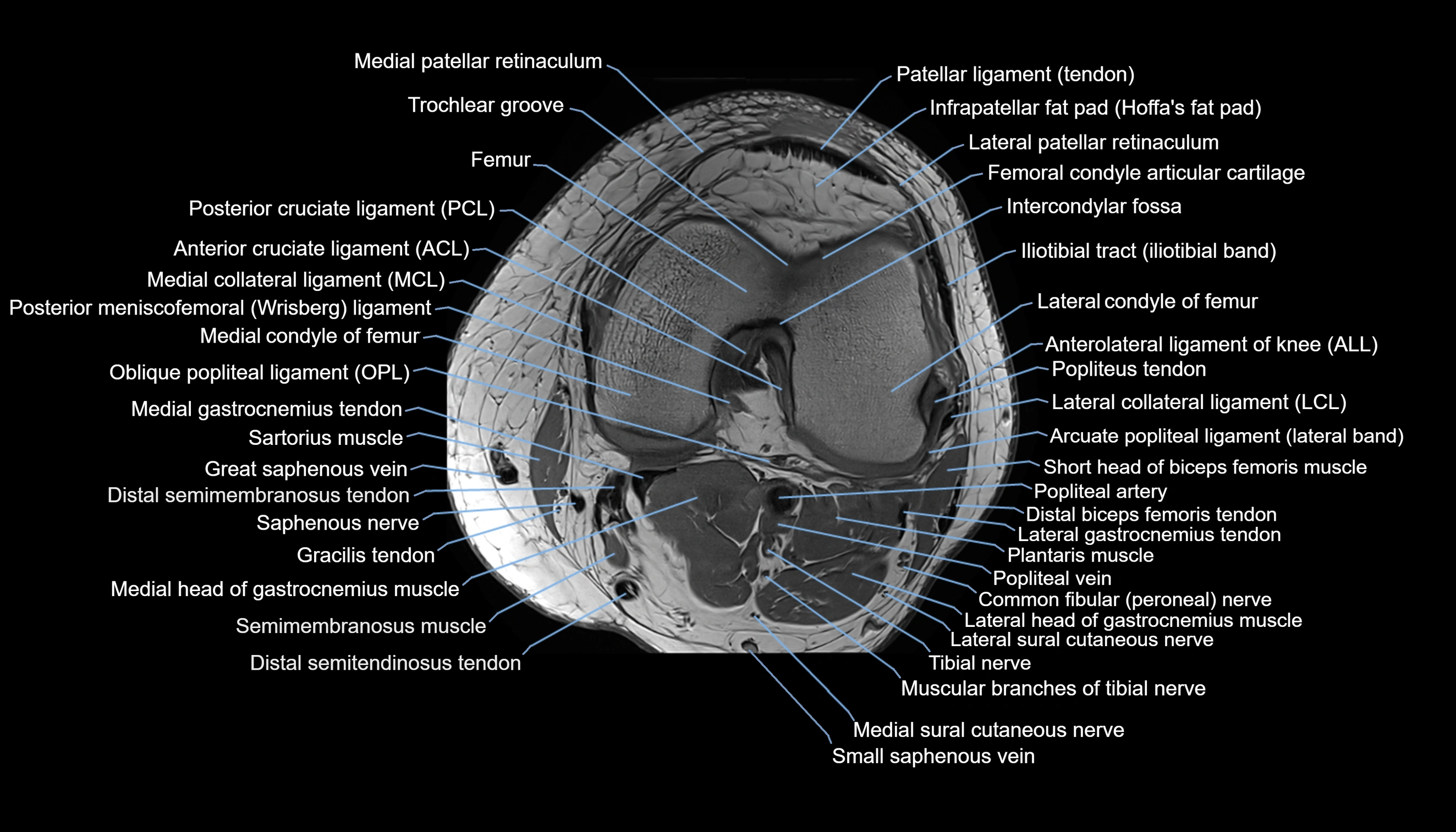 MRI knee  axial cross sectional anatomy 3T radiology  image-img-00001-00025.webp